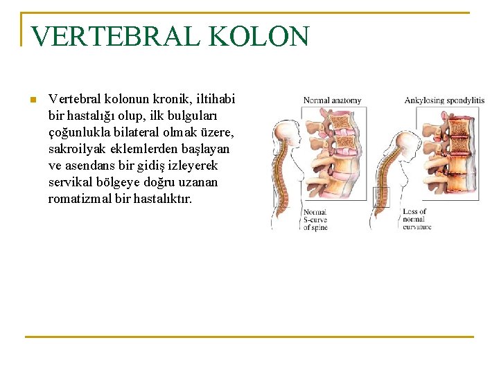 VERTEBRAL KOLON n Vertebral kolonun kronik, iltihabi bir hastalığı olup, ilk bulguları çoğunlukla bilateral VERTEBRAL KOLON n Vertebral kolonun kronik, iltihabi bir hastalığı olup, ilk bulguları çoğunlukla bilateral