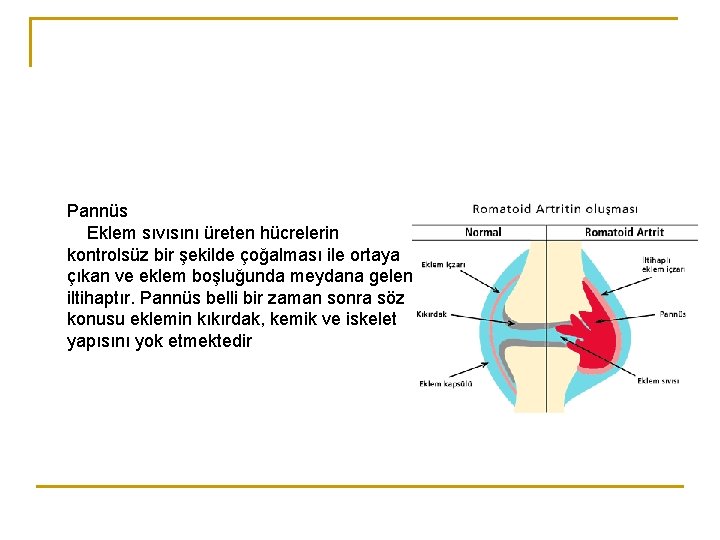 Pannüs Eklem sıvısını üreten hücrelerin kontrolsüz bir şekilde çoğalması ile ortaya çıkan ve eklem Pannüs Eklem sıvısını üreten hücrelerin kontrolsüz bir şekilde çoğalması ile ortaya çıkan ve eklem