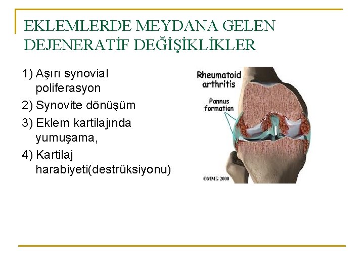 EKLEMLERDE MEYDANA GELEN DEJENERATİF DEĞİŞİKLİKLER 1) Aşırı synovial poliferasyon 2) Synovite dönüşüm 3) Eklem EKLEMLERDE MEYDANA GELEN DEJENERATİF DEĞİŞİKLİKLER 1) Aşırı synovial poliferasyon 2) Synovite dönüşüm 3) Eklem