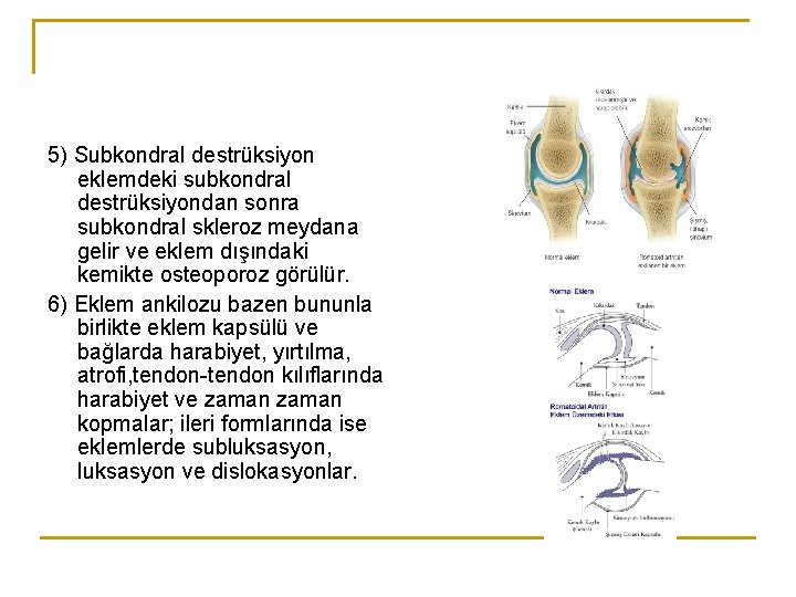 5) Subkondral destrüksiyon eklemdeki subkondral destrüksiyondan sonra subkondral skleroz meydana gelir ve eklem dışındaki 5) Subkondral destrüksiyon eklemdeki subkondral destrüksiyondan sonra subkondral skleroz meydana gelir ve eklem dışındaki