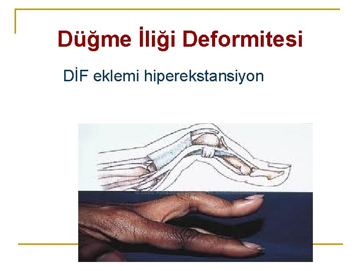 Düğme İliği Deformitesi DİF eklemi hiperekstansiyon Düğme İliği Deformitesi DİF eklemi hiperekstansiyon