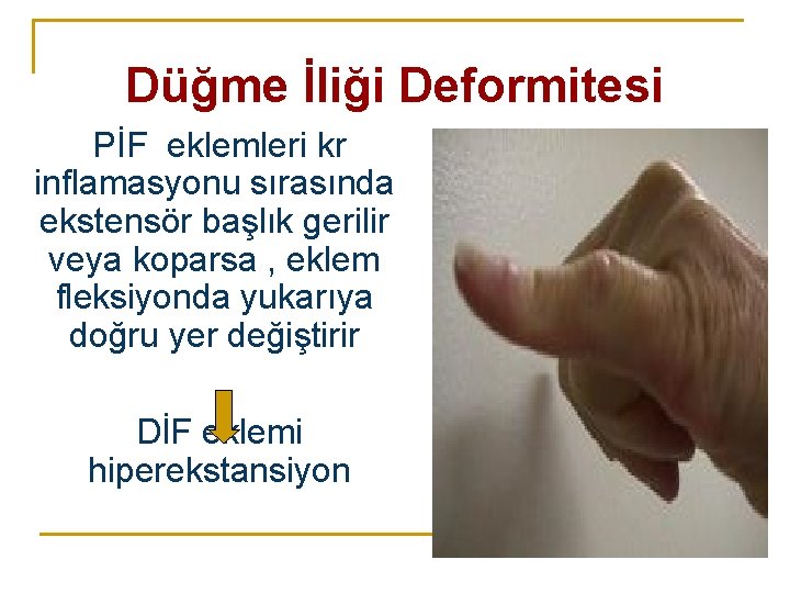 Düğme İliği Deformitesi PİF eklemleri kr inflamasyonu sırasında ekstensör başlık gerilir veya koparsa , Düğme İliği Deformitesi PİF eklemleri kr inflamasyonu sırasında ekstensör başlık gerilir veya koparsa ,