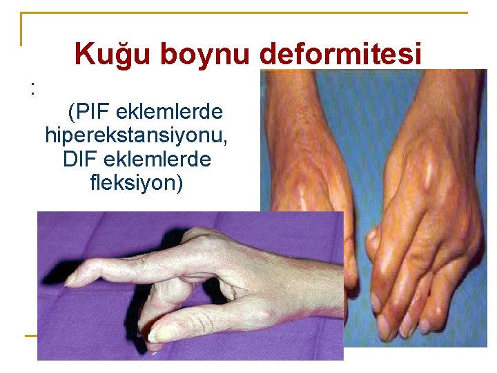 Kuğu boynu deformitesi : (PIF eklemlerde hiperekstansiyonu, DIF eklemlerde fleksiyon) Kuğu boynu deformitesi : (PIF eklemlerde hiperekstansiyonu, DIF eklemlerde fleksiyon)