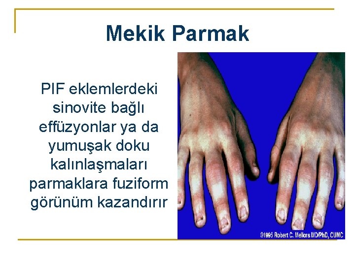 Mekik Parmak PIF eklemlerdeki sinovite bağlı effüzyonlar ya da yumuşak doku kalınlaşmaları parmaklara fuziform Mekik Parmak PIF eklemlerdeki sinovite bağlı effüzyonlar ya da yumuşak doku kalınlaşmaları parmaklara fuziform