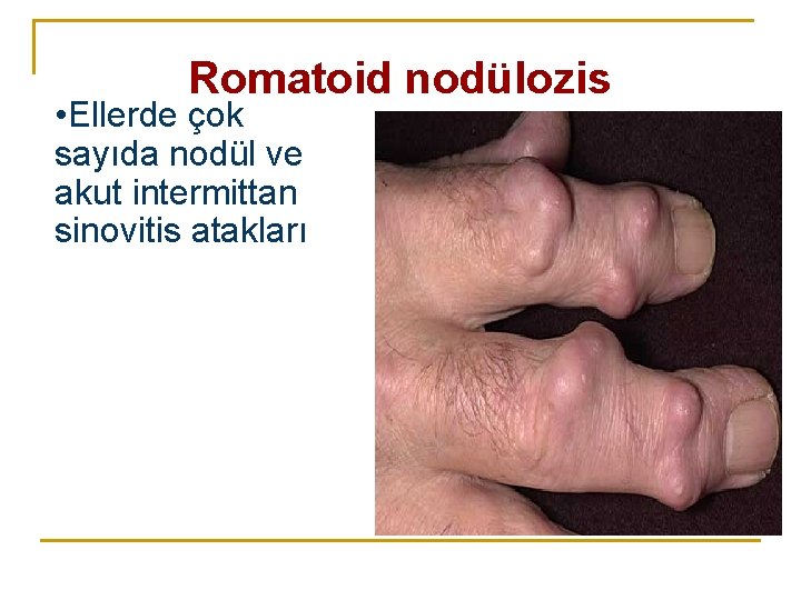 Romatoid nodülozis • Ellerde çok sayıda nodül ve akut intermittan sinovitis atakları Romatoid nodülozis • Ellerde çok sayıda nodül ve akut intermittan sinovitis atakları