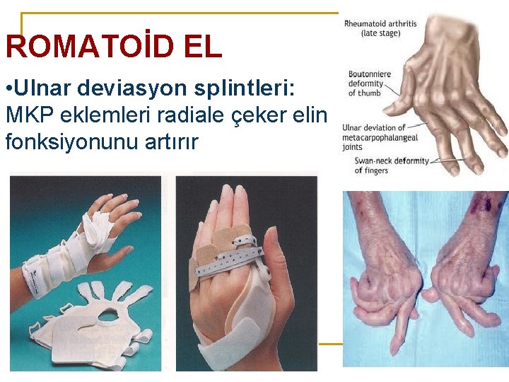 ROMATOİD EL • Ulnar deviasyon splintleri: MKP eklemleri radiale çeker elin fonksiyonunu artırır ROMATOİD EL • Ulnar deviasyon splintleri: MKP eklemleri radiale çeker elin fonksiyonunu artırır