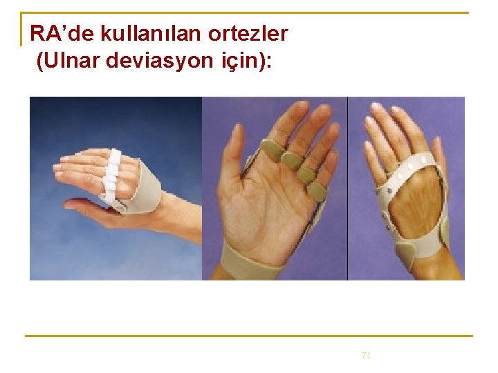 RA’de kullanılan ortezler (Ulnar deviasyon için): 71 RA’de kullanılan ortezler (Ulnar deviasyon için): 71
