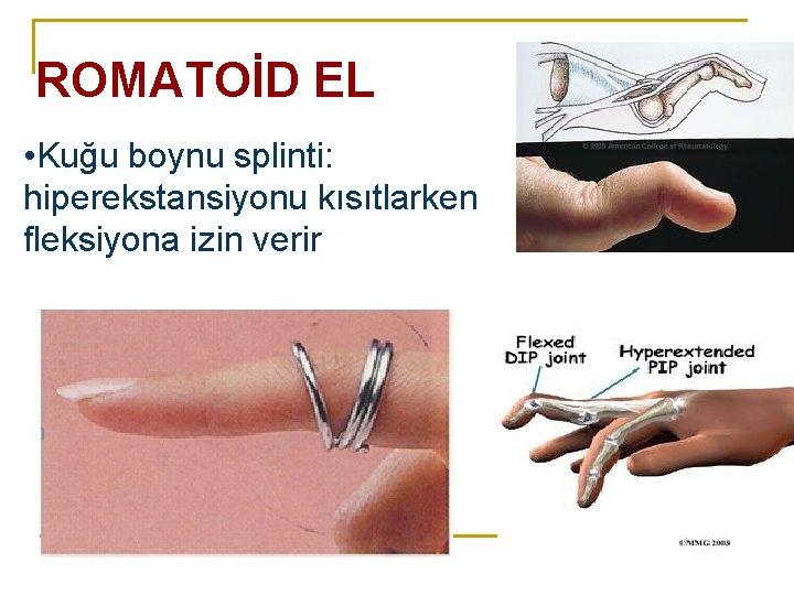 ROMATOİD EL • Kuğu boynu splinti: hiperekstansiyonu kısıtlarken fleksiyona izin verir ROMATOİD EL • Kuğu boynu splinti: hiperekstansiyonu kısıtlarken fleksiyona izin verir