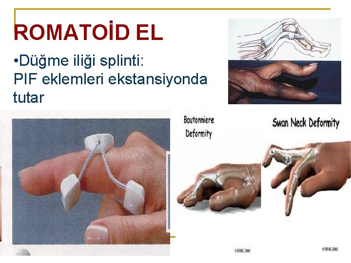 ROMATOİD EL • Düğme iliği splinti: PIF eklemleri ekstansiyonda tutar ROMATOİD EL • Düğme iliği splinti: PIF eklemleri ekstansiyonda tutar