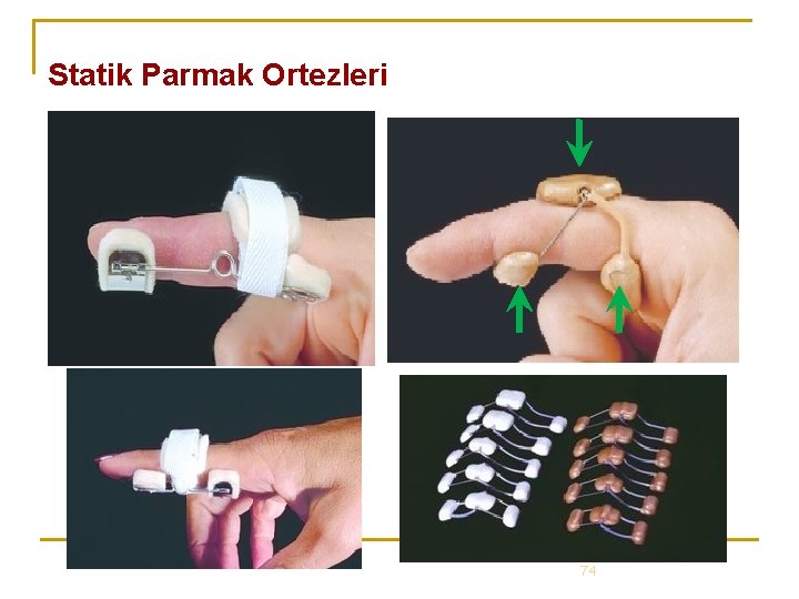 Statik Parmak Ortezleri 74 Statik Parmak Ortezleri 74