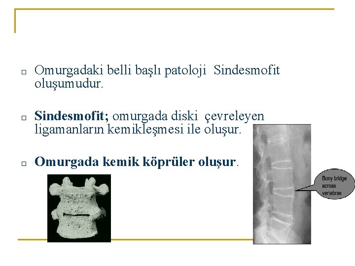 □ Omurgadaki belli başlı patoloji Sindesmofit oluşumudur. □ Sindesmofit; omurgada diski çevreleyen ligamanların kemikleşmesi □ Omurgadaki belli başlı patoloji Sindesmofit oluşumudur. □ Sindesmofit; omurgada diski çevreleyen ligamanların kemikleşmesi