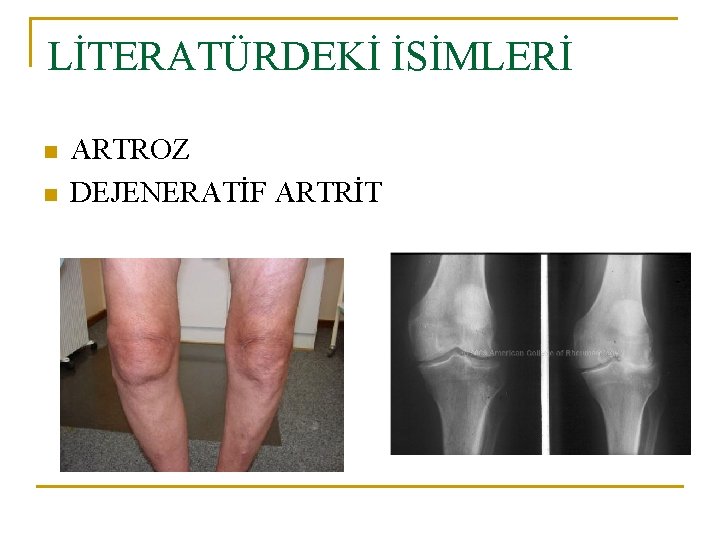 LİTERATÜRDEKİ İSİMLERİ n n ARTROZ DEJENERATİF ARTRİT LİTERATÜRDEKİ İSİMLERİ n n ARTROZ DEJENERATİF ARTRİT