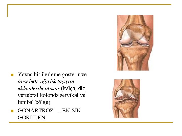 n n Yavaş bir ilerleme gösterir ve öncelikle ağırlık taşıyan eklemlerde oluşur. (kalça, diz, n n Yavaş bir ilerleme gösterir ve öncelikle ağırlık taşıyan eklemlerde oluşur. (kalça, diz,