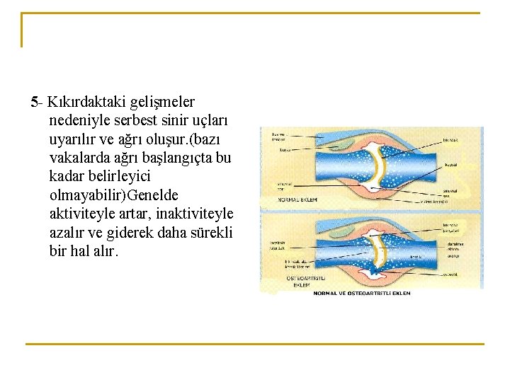 5 - Kıkırdaktaki gelişmeler nedeniyle serbest sinir uçları uyarılır ve ağrı oluşur. (bazı vakalarda 5 - Kıkırdaktaki gelişmeler nedeniyle serbest sinir uçları uyarılır ve ağrı oluşur. (bazı vakalarda