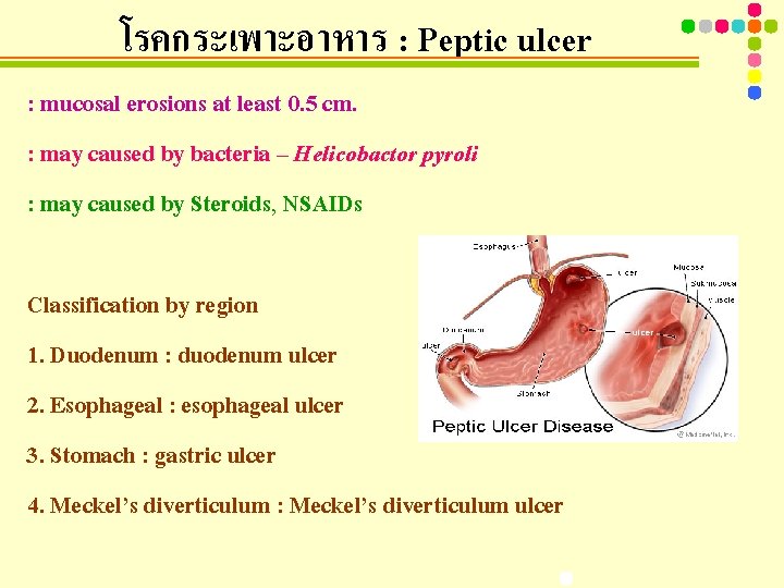 โรคกระเพาะอาหาร : Peptic ulcer : mucosal erosions at least 0. 5 cm. : may