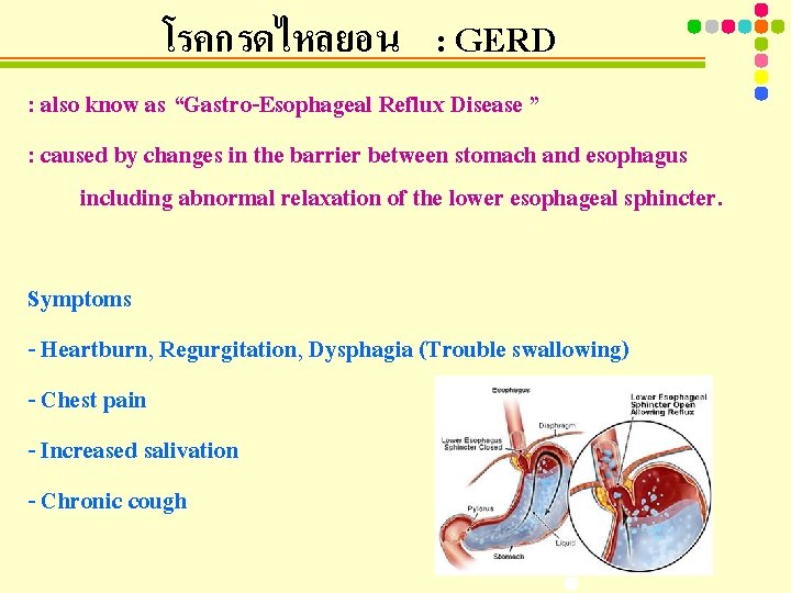 โรคกรดไหลยอน : GERD : also know as “Gastro-Esophageal Reflux Disease ” : caused by