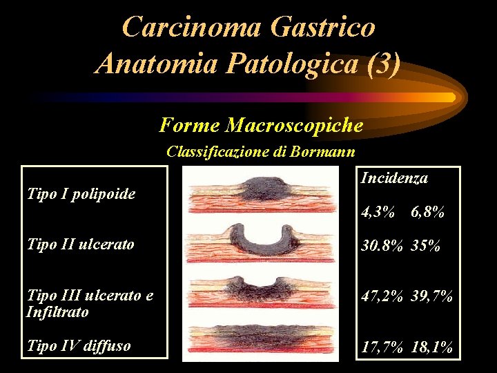 Carcinoma Gastrico Anatomia Patologica (3) Forme Macroscopiche Classificazione di Bormann Tipo I polipoide Incidenza Carcinoma Gastrico Anatomia Patologica (3) Forme Macroscopiche Classificazione di Bormann Tipo I polipoide Incidenza