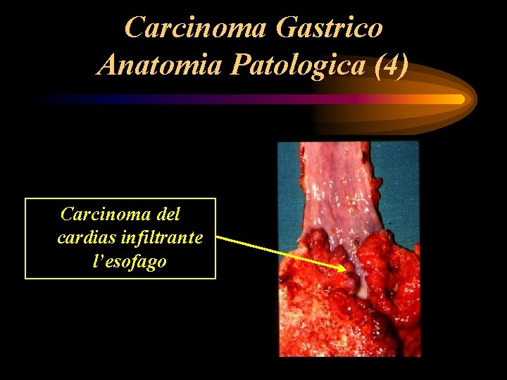 Carcinoma Gastrico Anatomia Patologica (4) Carcinoma del cardias infiltrante l’esofago Carcinoma Gastrico Anatomia Patologica (4) Carcinoma del cardias infiltrante l’esofago