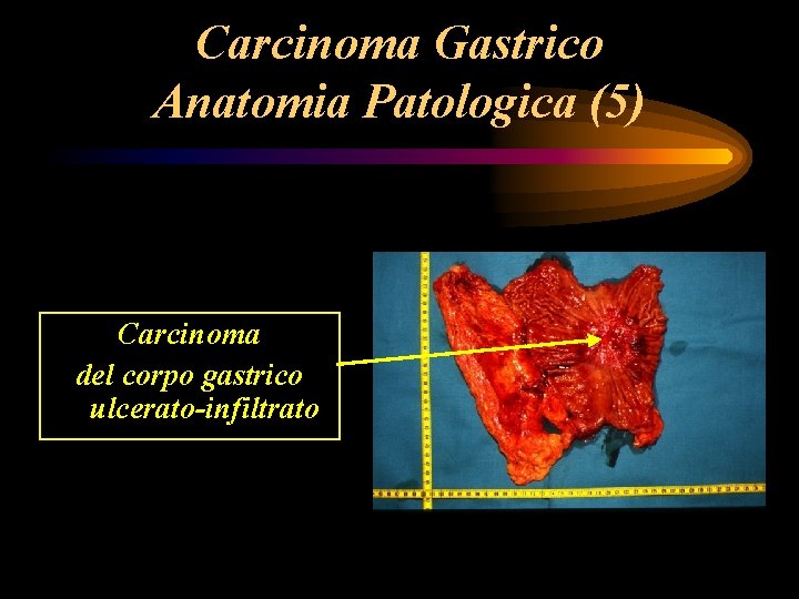 Carcinoma Gastrico Anatomia Patologica (5) Carcinoma del corpo gastrico ulcerato-infiltrato Carcinoma Gastrico Anatomia Patologica (5) Carcinoma del corpo gastrico ulcerato-infiltrato