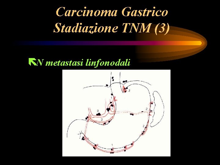 Carcinoma Gastrico Stadiazione TNM (3) ëN metastasi linfonodali Carcinoma Gastrico Stadiazione TNM (3) ëN metastasi linfonodali