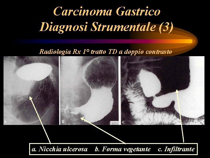 Carcinoma Gastrico Diagnosi Strumentale (3) Radiologia Rx 1° tratto TD a doppio contrasto a. Carcinoma Gastrico Diagnosi Strumentale (3) Radiologia Rx 1° tratto TD a doppio contrasto a.