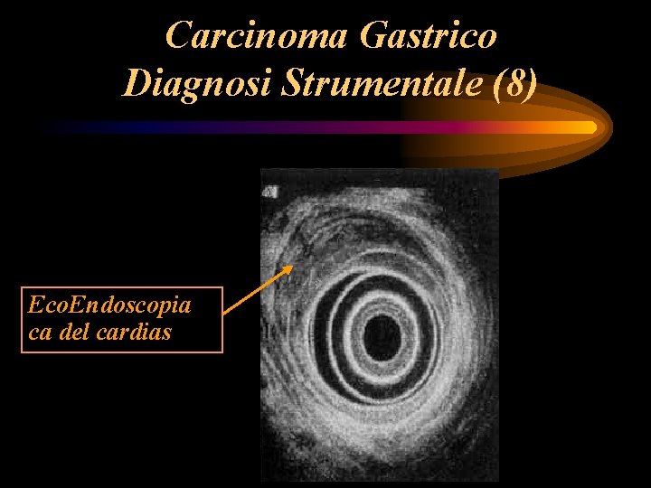 Carcinoma Gastrico Diagnosi Strumentale (8) Eco. Endoscopia ca del cardias Carcinoma Gastrico Diagnosi Strumentale (8) Eco. Endoscopia ca del cardias