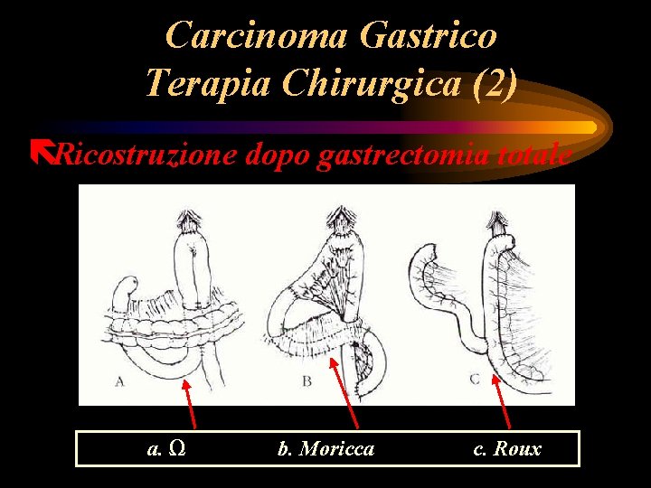 Carcinoma Gastrico Terapia Chirurgica (2) ëRicostruzione dopo gastrectomia totale a. Ω b. Moricca c. Carcinoma Gastrico Terapia Chirurgica (2) ëRicostruzione dopo gastrectomia totale a. Ω b. Moricca c.