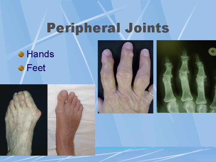 Peripheral Joints Hands Feet 