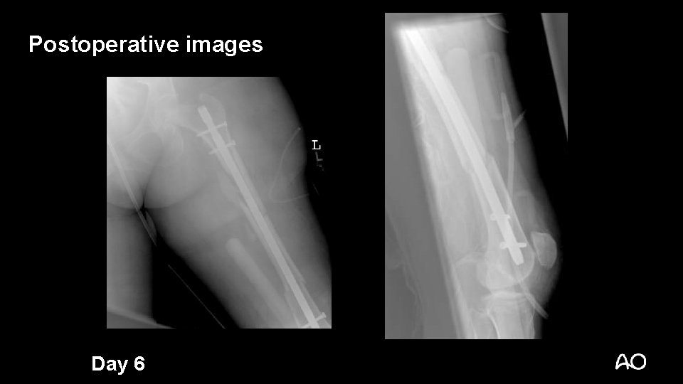 Postoperative images Day 6 