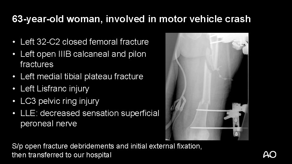 63 -year-old woman, involved in motor vehicle crash • Left 32 -C 2 closed