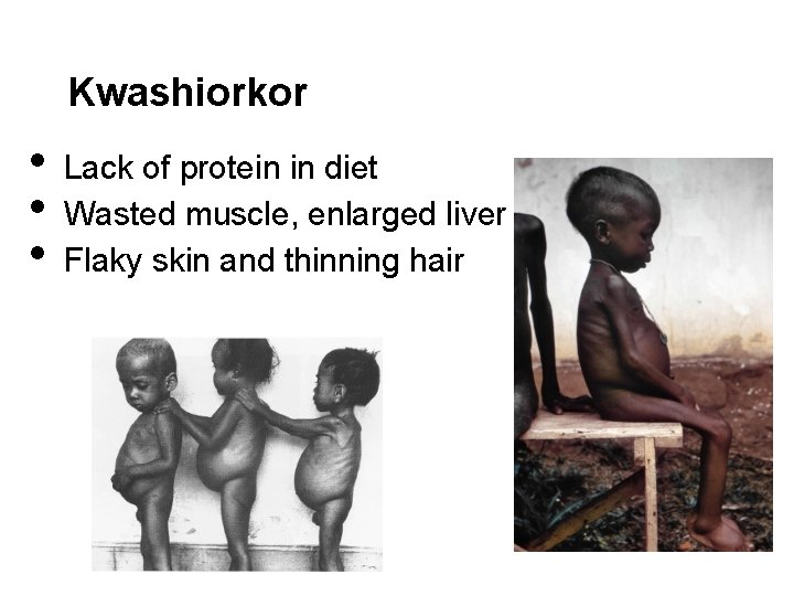 Kwashiorkor • • • Lack of protein in diet Wasted muscle, enlarged liver Flaky