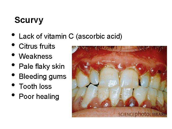 Scurvy • • Lack of vitamin C (ascorbic acid) Citrus fruits Weakness Pale flaky