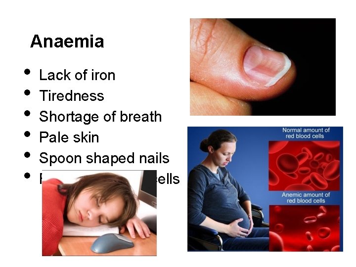 Anaemia • • • Lack of iron Tiredness Shortage of breath Pale skin Spoon