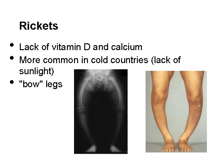 Rickets • • • Lack of vitamin D and calcium More common in cold