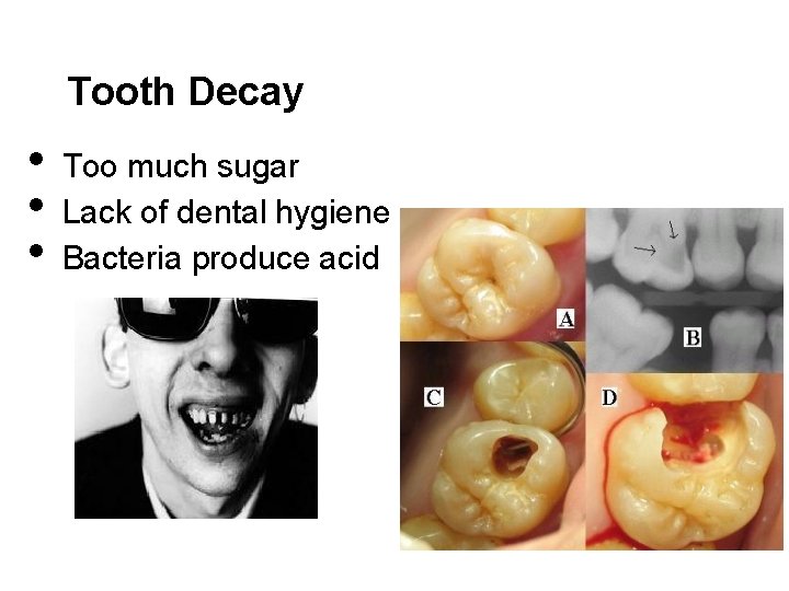Tooth Decay • • • Too much sugar Lack of dental hygiene Bacteria produce