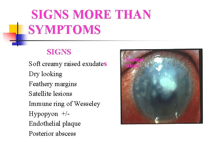 SIGNS MORE THAN SYMPTOMS SIGNS Soft creamy raised exudates Dry looking Feathery margins Satellite