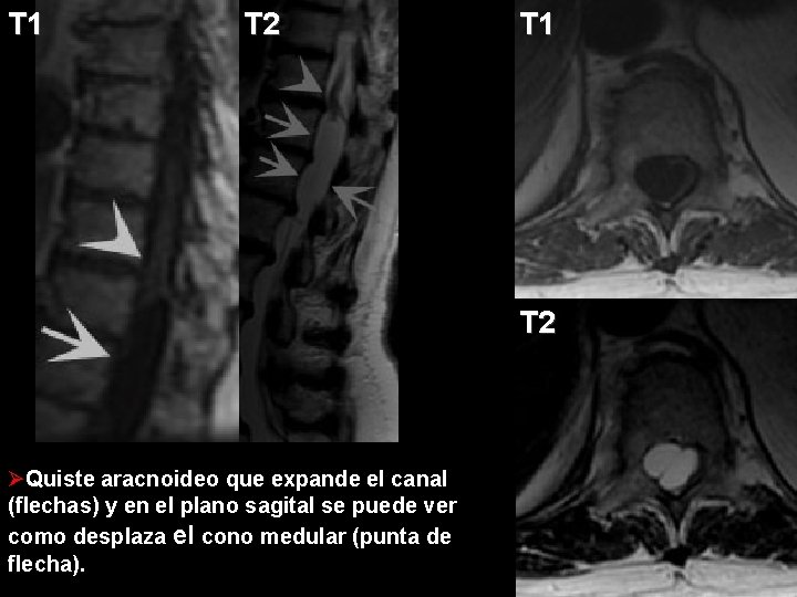 T 1 T 2 ØQuiste aracnoideo que expande el canal (flechas) y en el