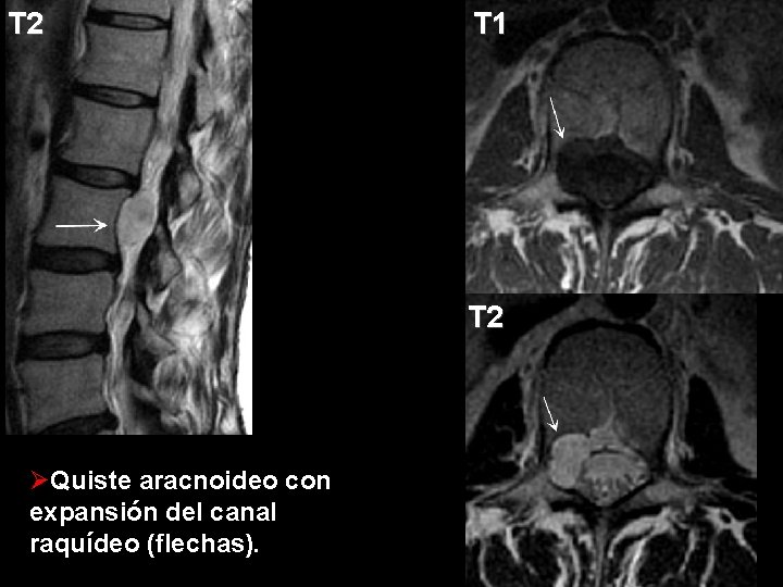 T 2 T 1 T 2 ØQuiste aracnoideo con expansión del canal raquídeo (flechas).