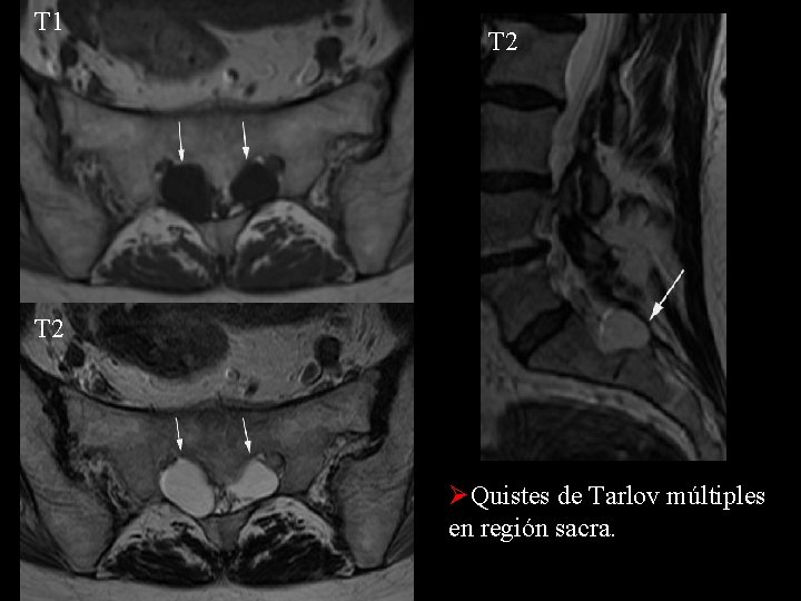 T 1 T 2 ØQuistes de Tarlov múltiples en región sacra. 