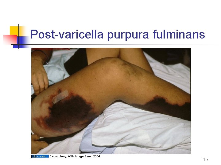 Post-varicella purpura fulminans De. Loughery, ASH Image Bank, 2004 15 