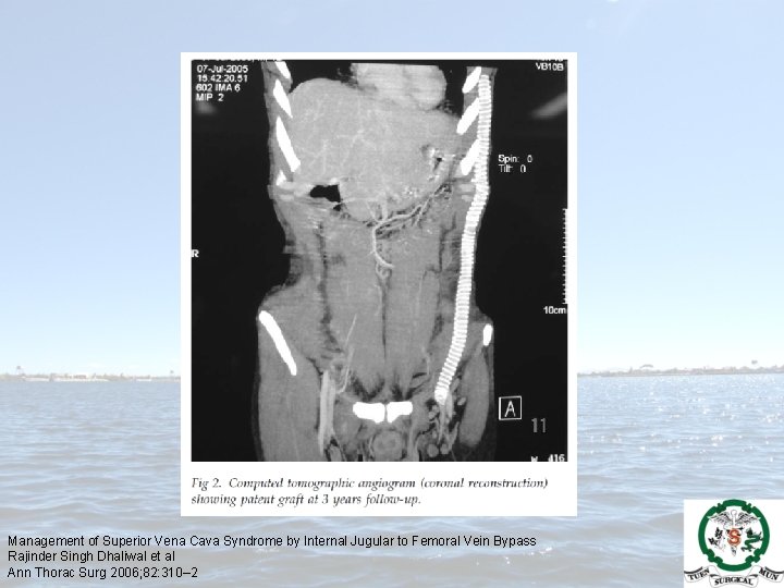 Management of Superior Vena Cava Syndrome by Internal Jugular to Femoral Vein Bypass Rajinder