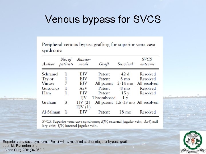 Venous bypass for SVCS Superior vena cava syndrome: Relief with a modified saphenojugular bypass