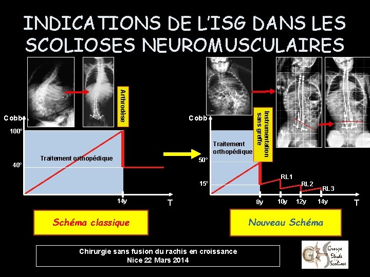 INDICATIONS DE L’ISG DANS LES SCOLIOSES NEUROMUSCULAIRES Cobb 100° 40° Traitement orthopédique 50° Instrumentation