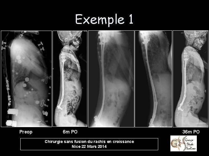 Exemple 1 Preop 6 m PO Chirurgie sans fusion du rachis en croissance Nice