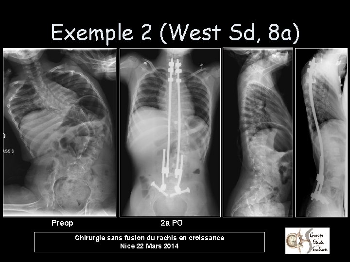 Exemple 2 (West Sd, 8 a) Preop 2 a PO Chirurgie sans fusion du
