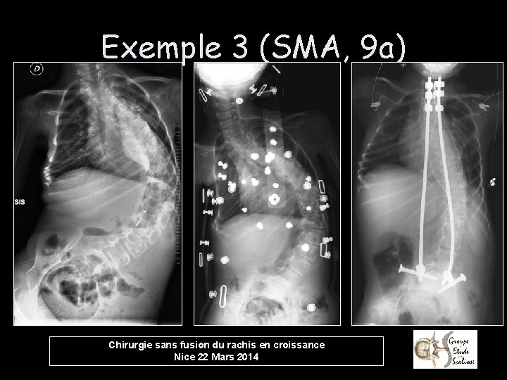 Exemple 3 (SMA, 9 a) Chirurgie sans fusion du rachis en croissance Nice 22