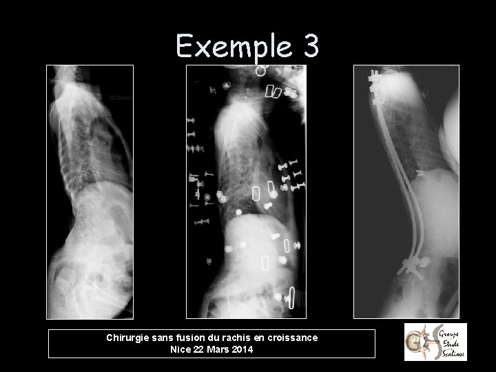Exemple 3 Chirurgie sans fusion du rachis en croissance Nice 22 Mars 2014 