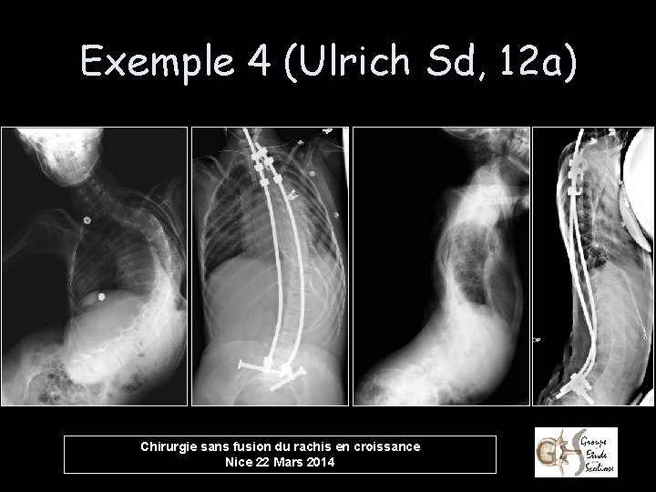 Exemple 4 (Ulrich Sd, 12 a) Chirurgie sans fusion du rachis en croissance Nice