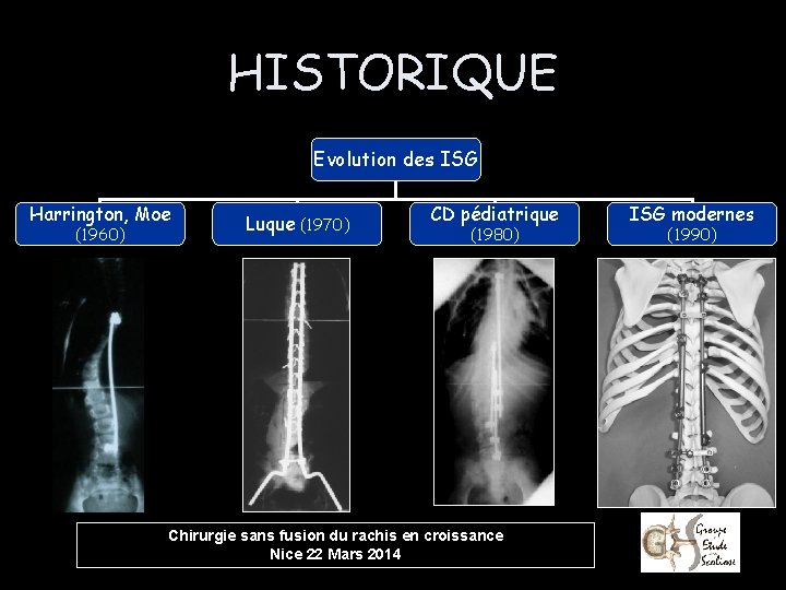 HISTORIQUE Evolution des ISG Harrington, Moe (1960) Luque (1970) CD pédiatrique (1980) Chirurgie sans