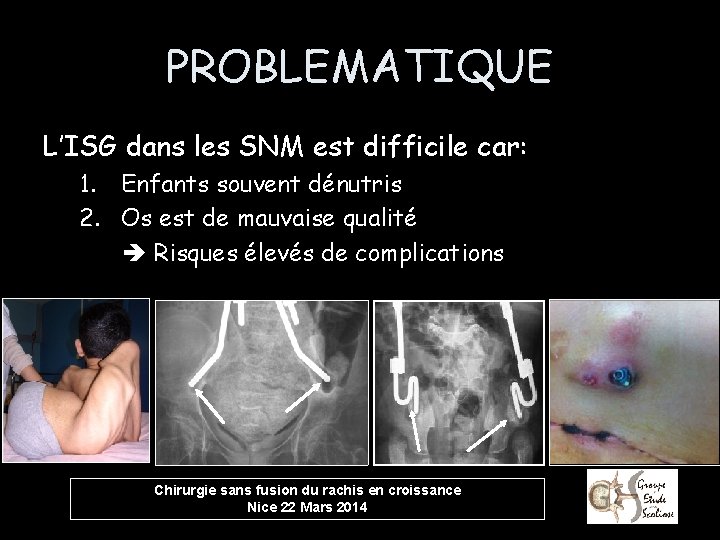 PROBLEMATIQUE L’ISG dans les SNM est difficile car: 1. Enfants souvent dénutris 2. Os